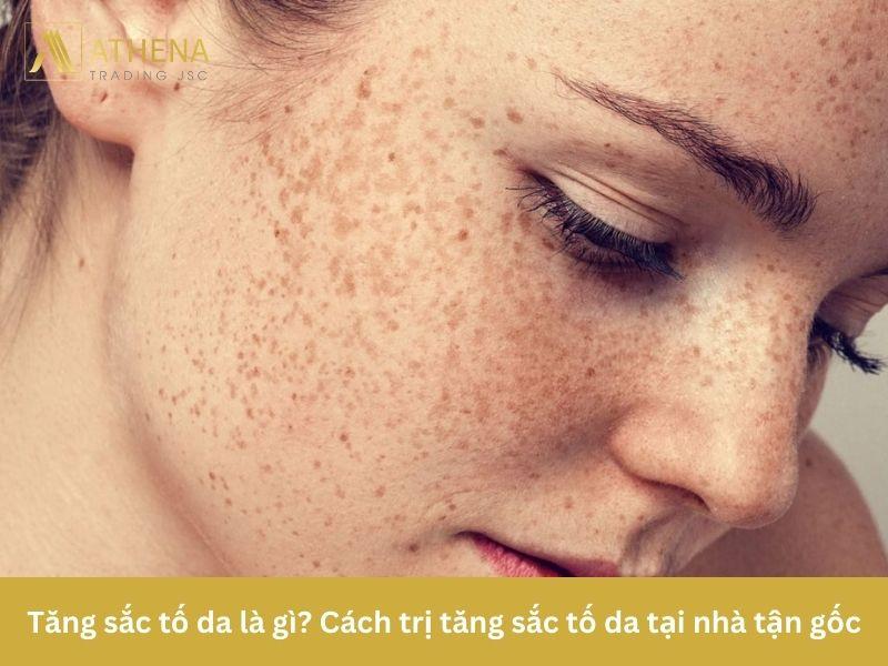 Tăng sắc tố da là gì - Cách trị tăng sắc tố da tại nhà tận gốc