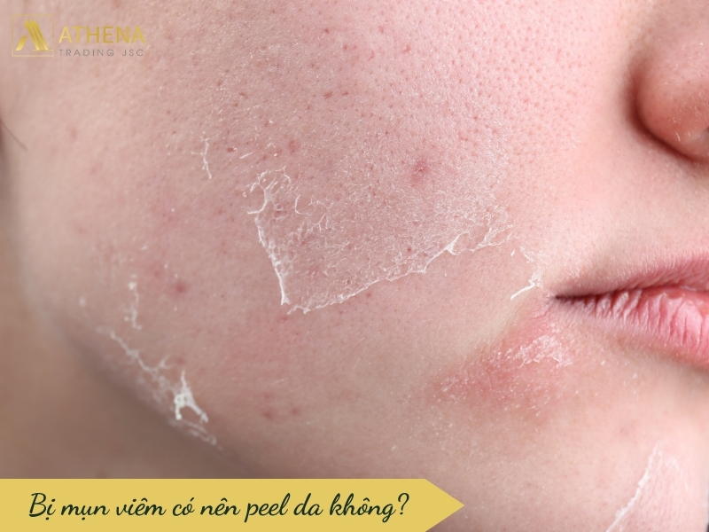 Bị mụn viêm có nên peel da không?