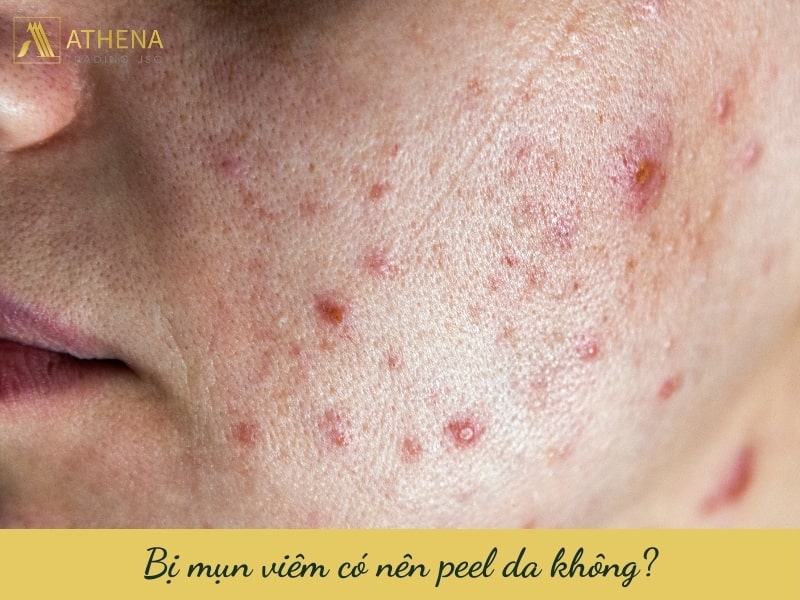 bị mụn viêm có nên peel da không?