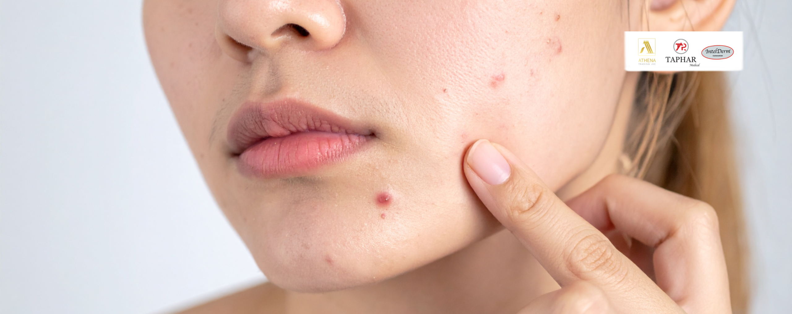 Trị thâm sau mụn hiệu quả: 7 cách giúp da sáng đều màu và phục hồi nhanh