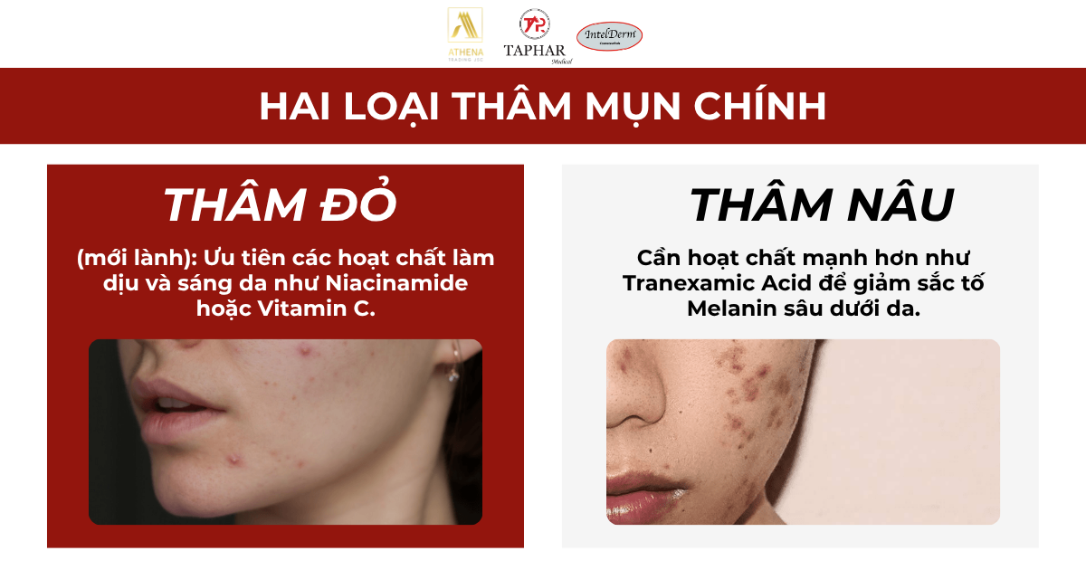 Hai loại thâm MỤN chính