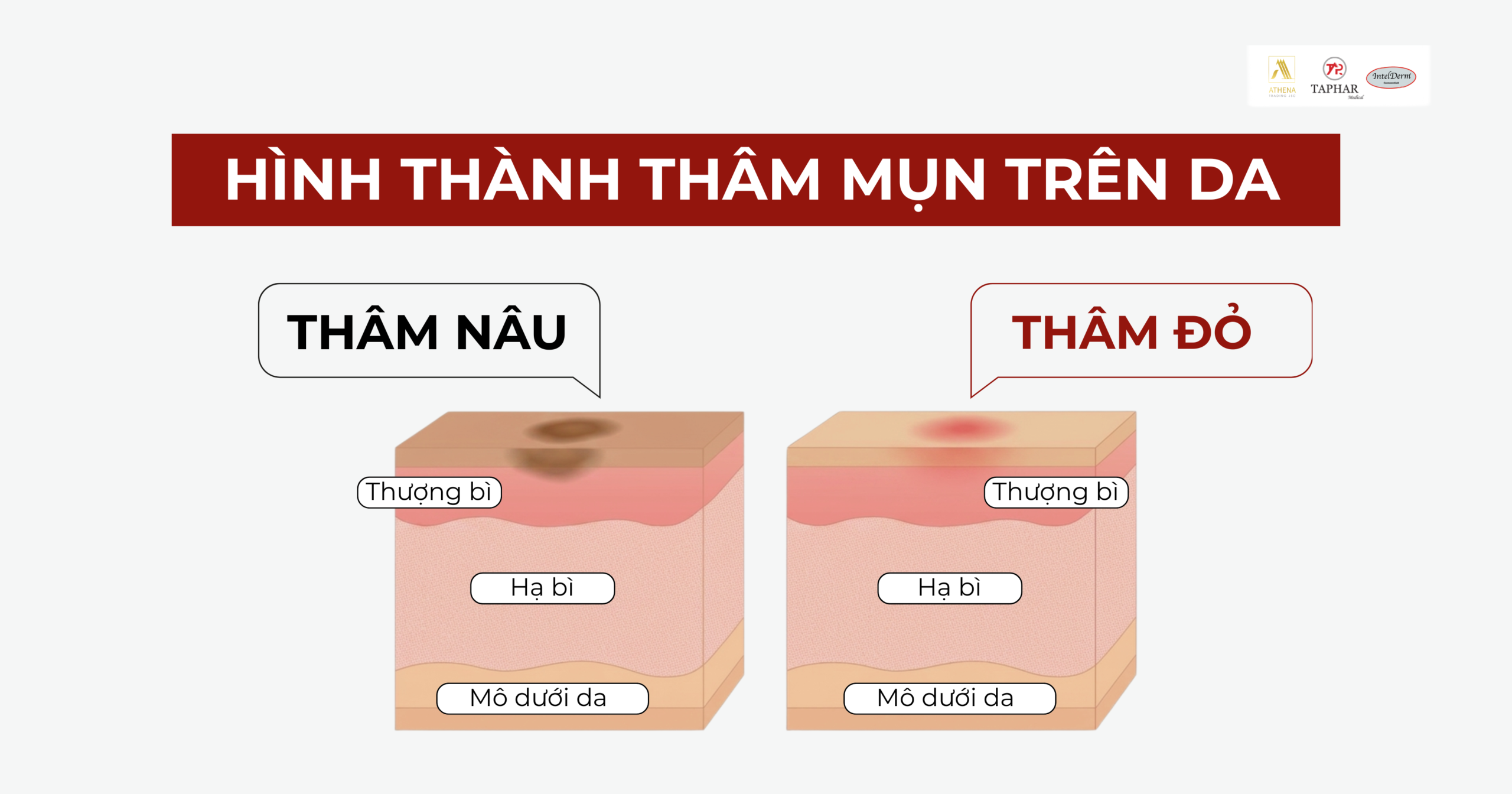 Quá trình viêm và tích tụ sắc tố Melanin hình thành thâm mụn đỏ và thâm nâu