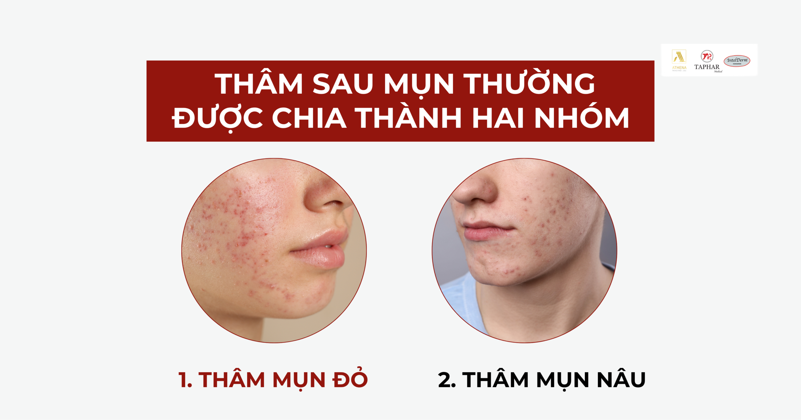 cách trị thâm mụn hiệu quả