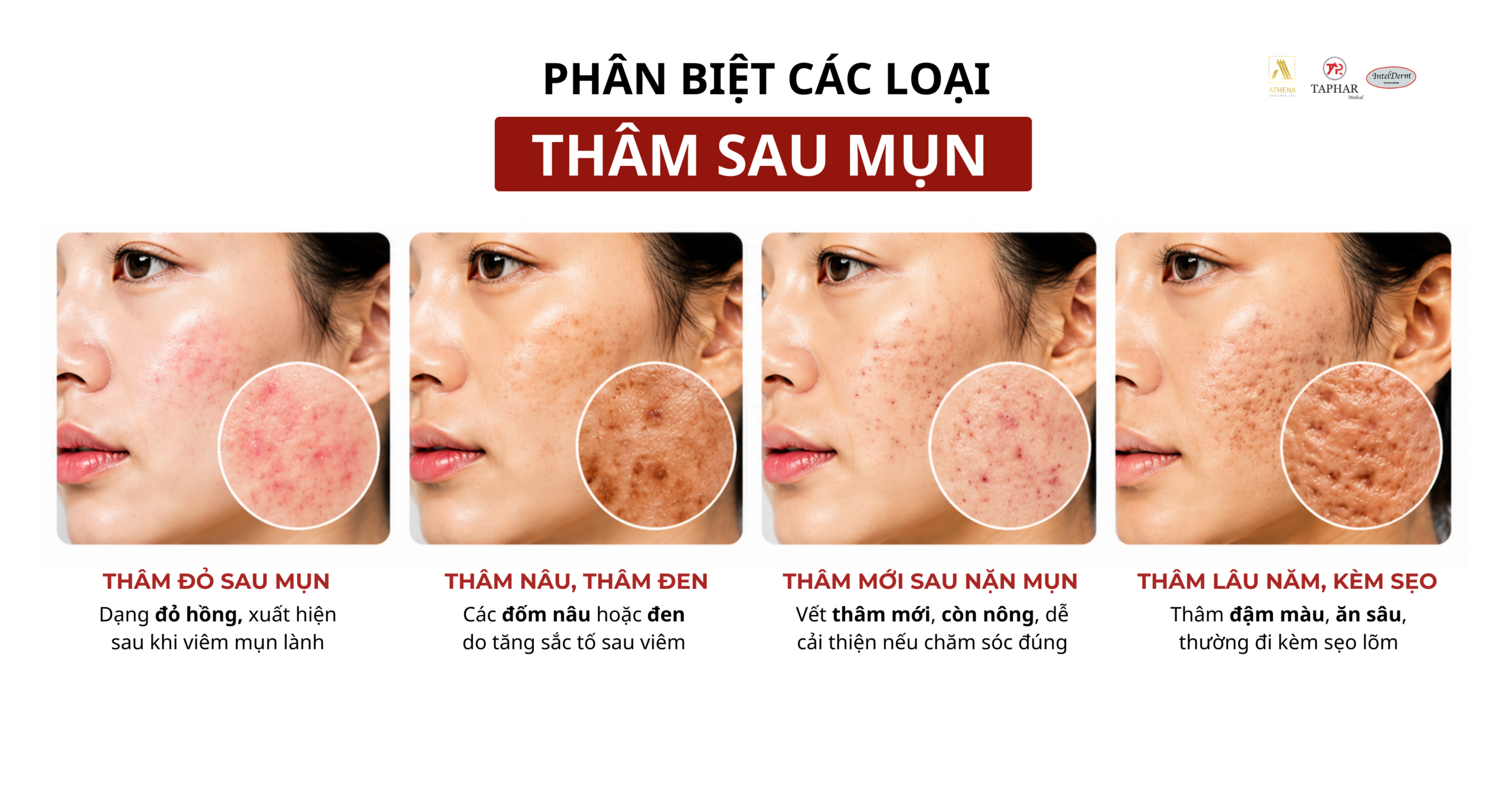 phân biệt các loại thâm sau mụn trước khi chọn sản phẩm 