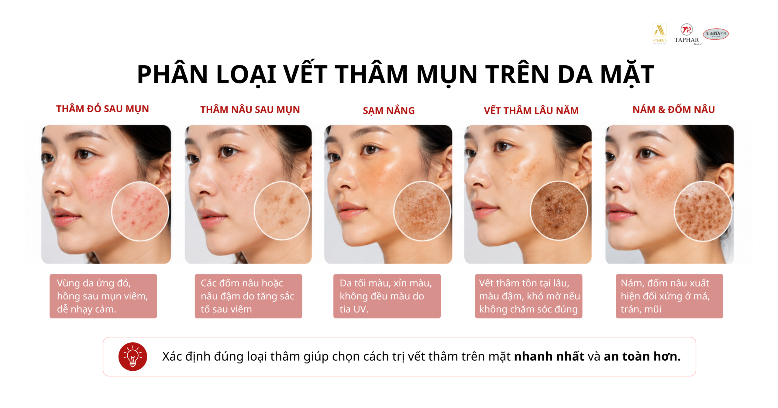 phân loại các vết thâm mụn 