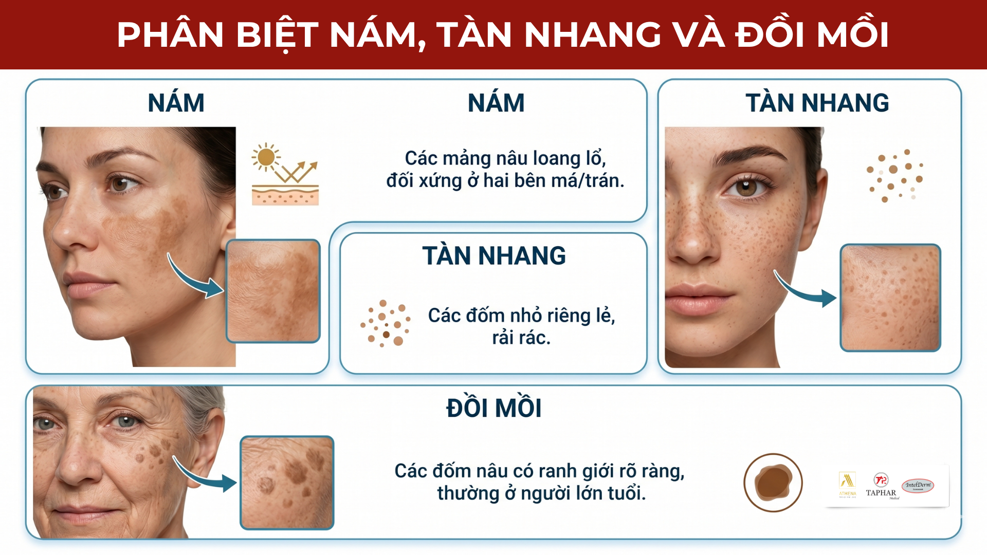 Phân biệt nám, tàn nhang và đồi mồi