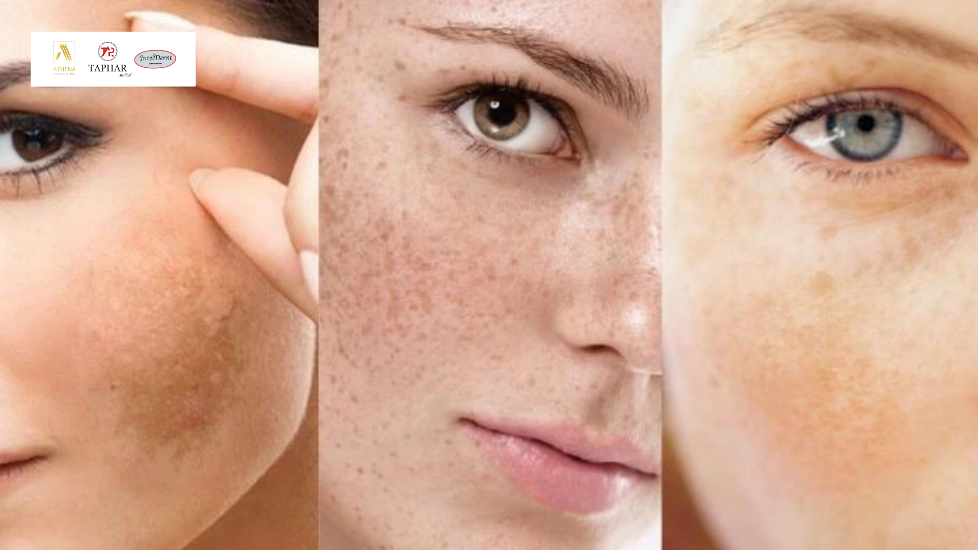 Trị nám tại nhà đúng cách với chống nắng và phục hồi da
