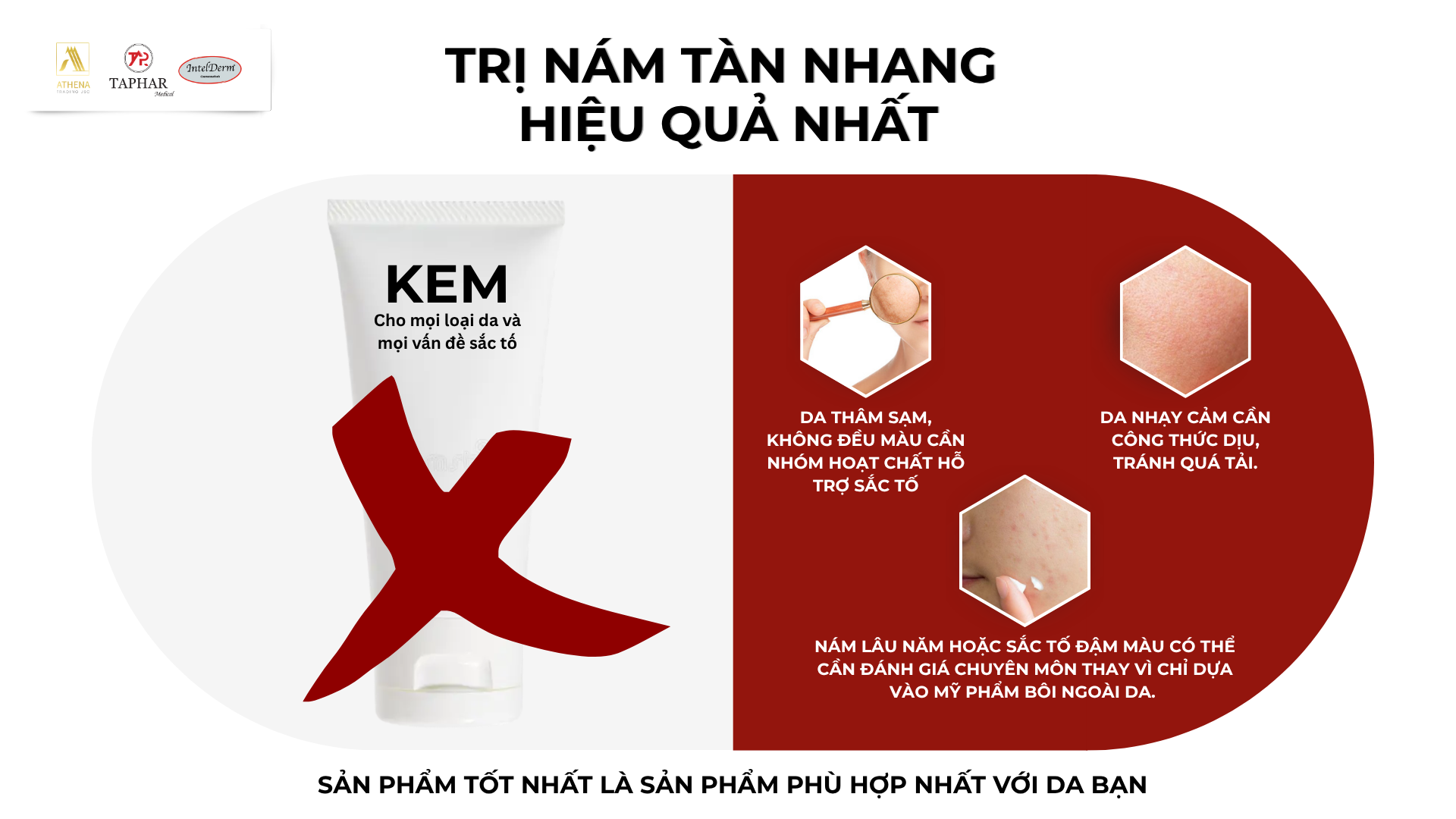 Trị nám tàn nhang hiệu quả nhất