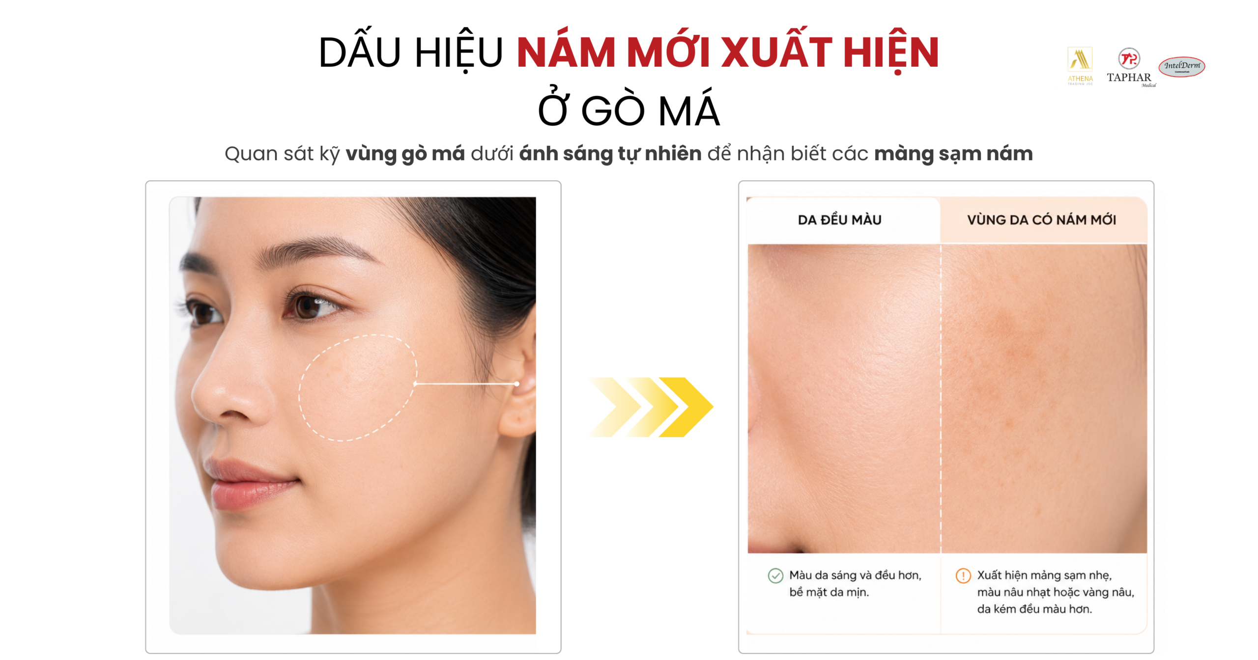nám ở gò má mới xuất hiện