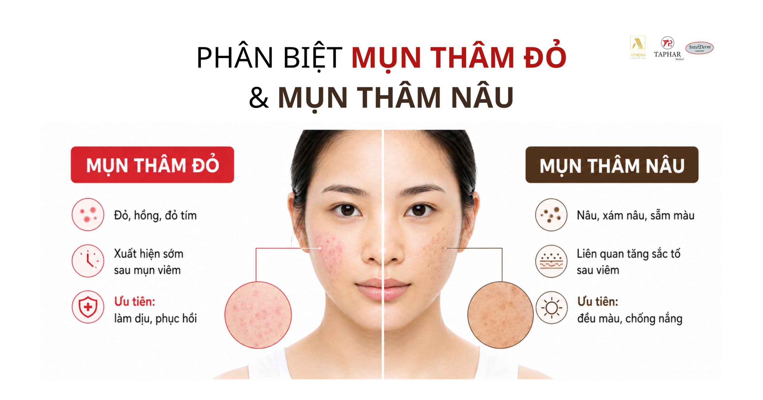 phân biệt thâm mụn đỏ và thâm mụn nâu