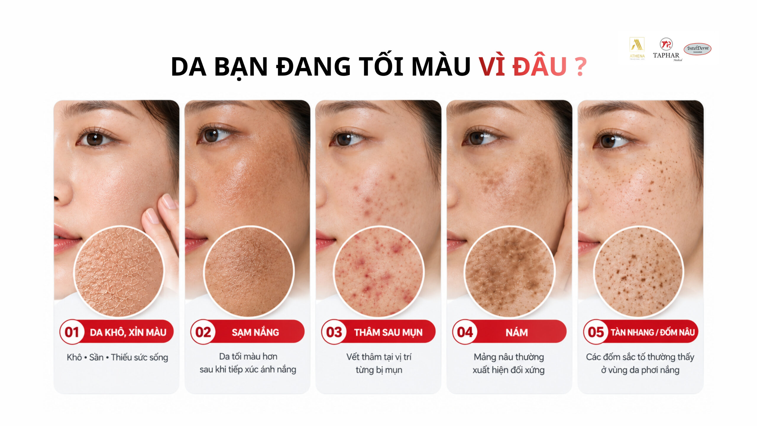 Phân biệt da xỉn màu, sạm nắng, thâm mụn, nám và tàn nhang