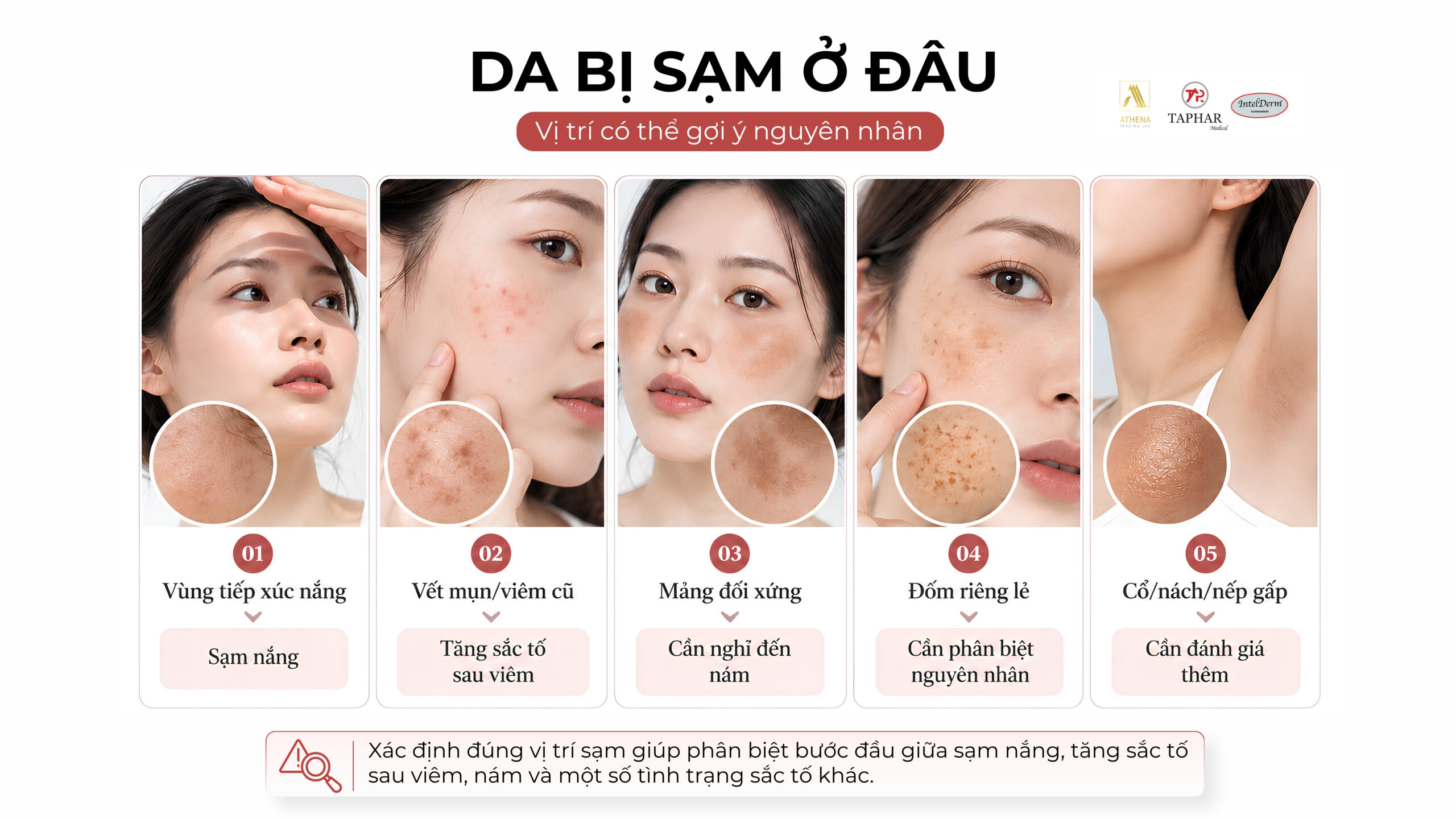 Vị trí da bị sạm có thể gợi ý nguyên nhân