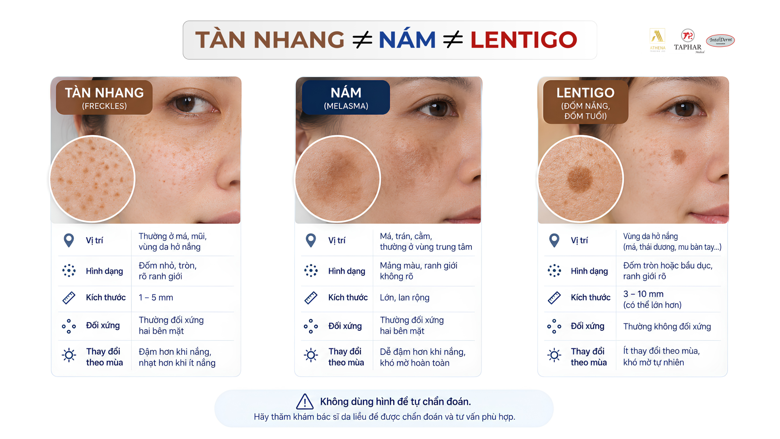 Phân biệt tàn nhang với nám và lentigo trên da mặt