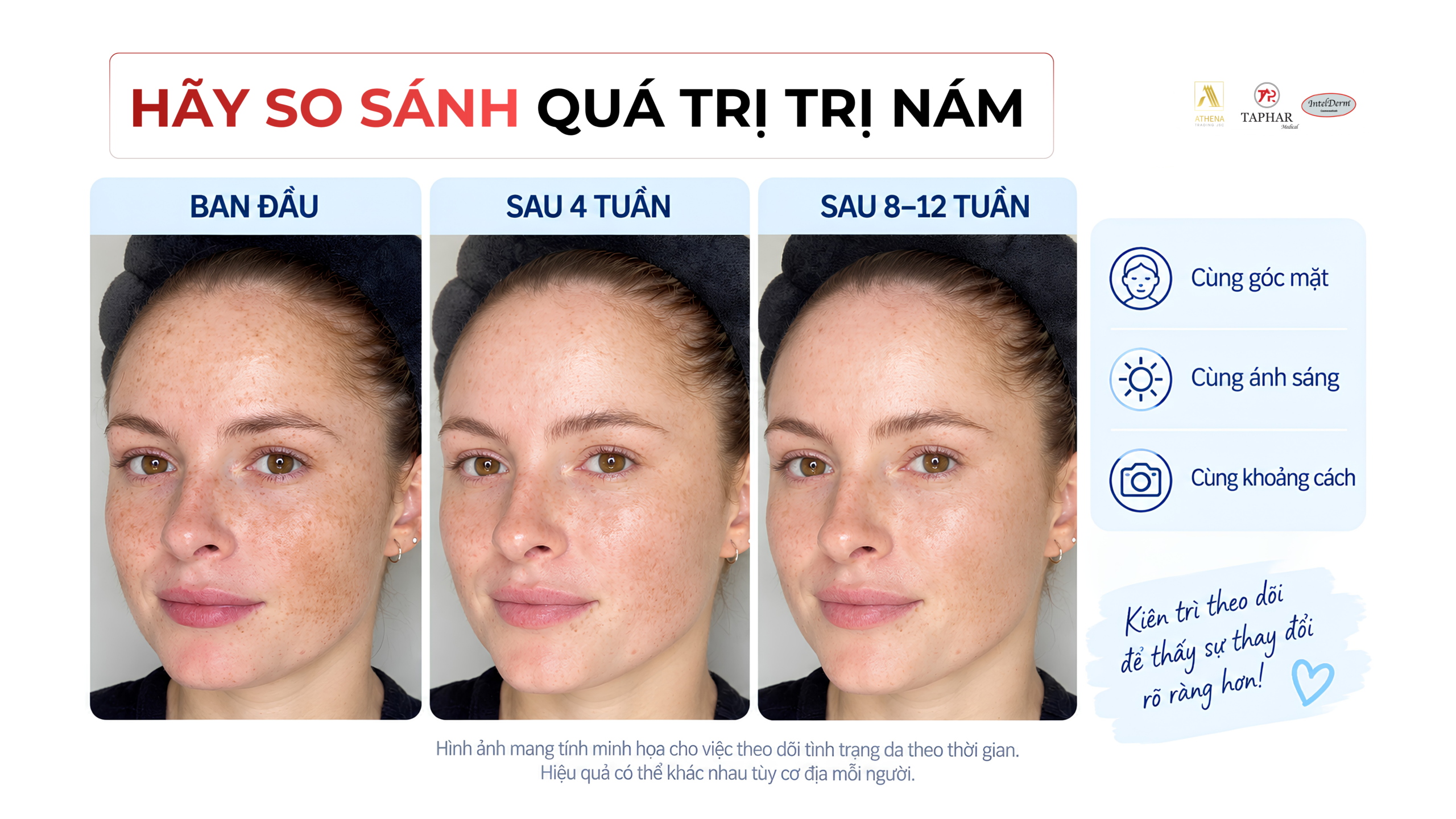 Theo dõi cách trị tàn nhang tại nhà bằng ảnh trước và sau
