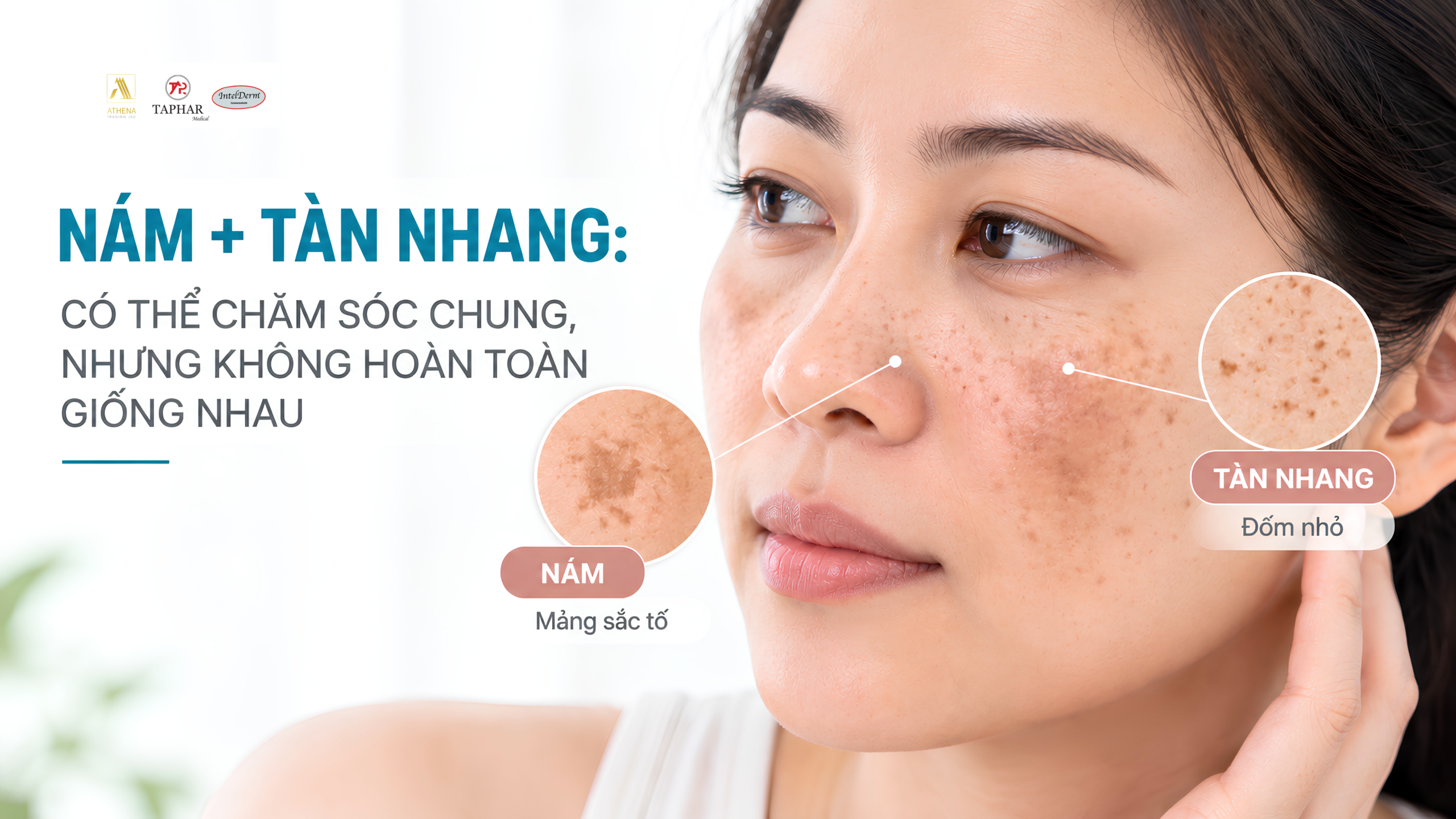 Trị nám tàn nhang khi trên mặt cùng xuất hiện nám và tàn nhang